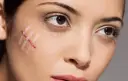 [Giải Đáp] Bị sẹo nên kiêng ăn gì để tránh Sẹo Lồi?
